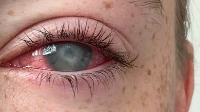 A blinding parasitic eye disease affects mostly contact lens wearers. Here’s how to avoid it