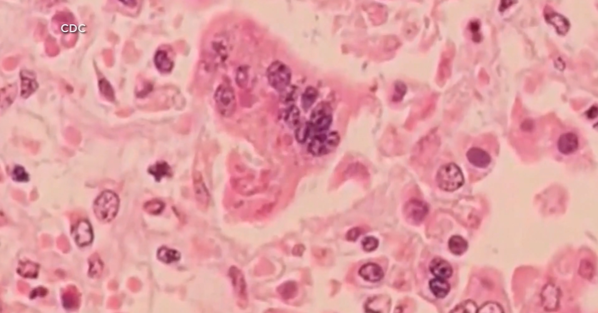 57 cases of measles confirmed at Ave Maria University, 7 currently contagious