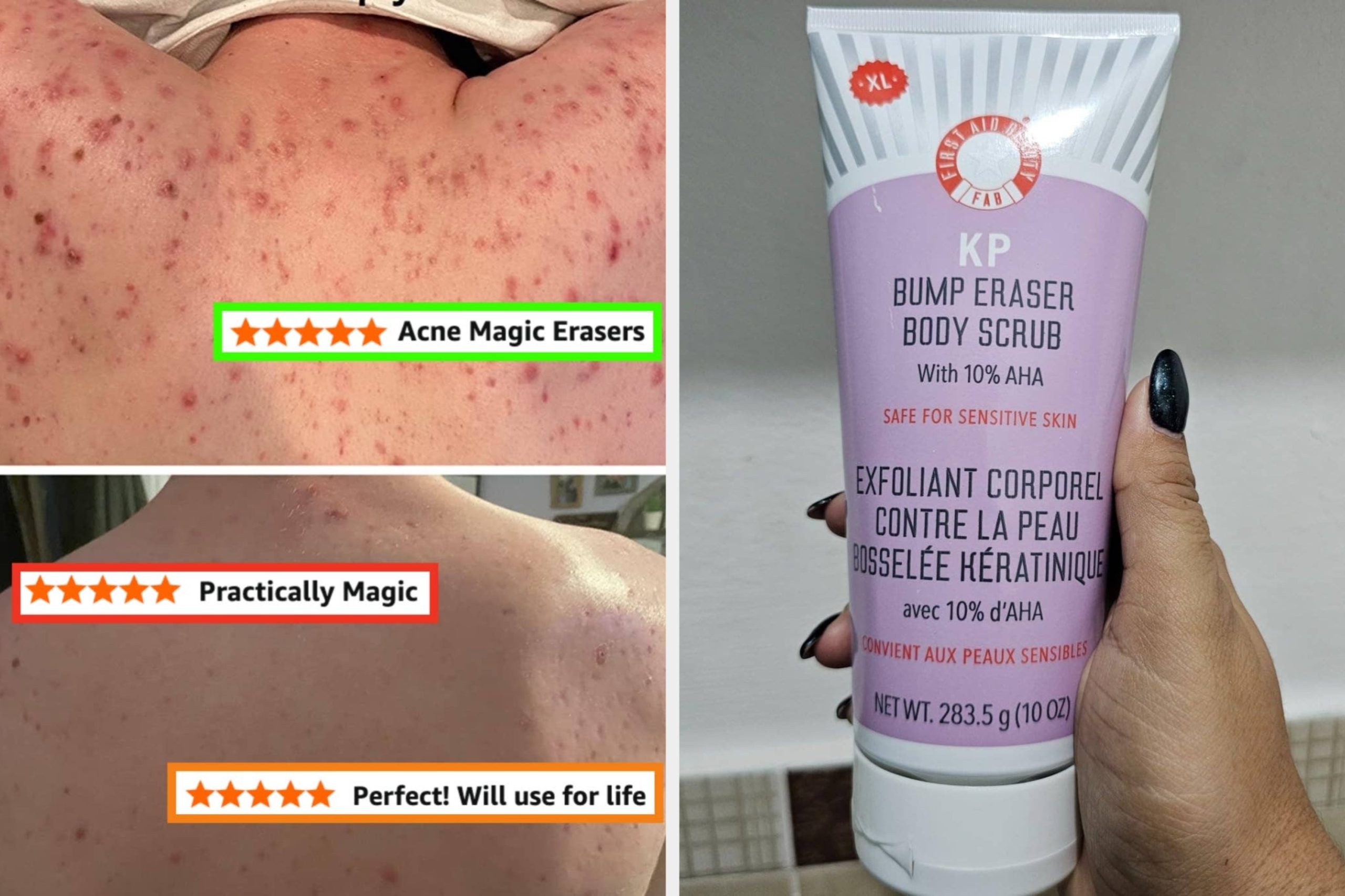 If You’ve Hit The “Body Acne” Part Of Your Skincare Journey, These 27 Products Can Help Combat It